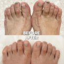 서초대로64길 76-21 | 문제성발톱 네일샵 반디인하우스 서초점 발톱 피멍 빼기 깨진발톱 케어 성공
