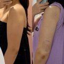 멍발란스 | 분당 다이어트 팔뚝 관리 지방흡입주사 달스주사 후기 당일부터 1주차 통증 붓기 멍