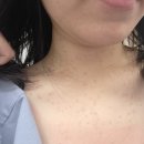 주심한의원 | 범계 한의원 편평사마귀 제거 레이저치료 통증 후기