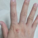 충대의료용품점 | [화폐상습진치료기] 대전 충남대학교병원 피부과 방문 후기, 피부염, 결절성양진, 아토피피부 (1화)