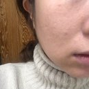 끌리어의원 | 구매 찬스/ 대구 끌리어피부과 PDT 관리 후기/ 전 나쁘지 않았어요, 꾸준히 관리후기 올릴게요 :)