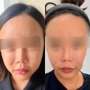 알파 - 광산구 장신로 51 | 원주 피부과 덴서티 알파 내돈내산후기, 효과 통증 비용 다운타임