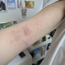 엄피부과의원 | 성인아토피 피부과 추천 &#39;계피부과의원&#39; 방문 진료후기(1번 원장님&amp;6번 원장님)