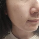스킨톡스 | 피부관리 | 청담 피부과 리쥬란 + 스킨보톡스 = 리쥬톡스 받은 솔직 후기(통증+회복기간+피부변화까지)