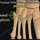 발가락 골절 - 제5중족골 기저부 골절 이미지