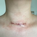 나은병원본관5층 | 9. 갑상선암 수술 후 흉터 레이저 치료 | 삼성서울병원 피부과