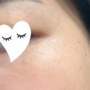 효령로33길1-20 | 뷰티라운지 방배점에서 잡티 제거하기 (내돈내산 피코스팟 후기)