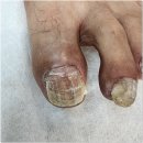 포쉬네일 풀리메디 안산점 | 안산발톱무좀 항암 중 생긴 발톱 변색 변형 고민 해결한 포쉬네일 동성제약 풀리메디 안산점