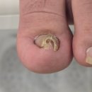 동두천-031 | 동두천 양주 연천 내성발톱 최고의 만족 케어 후기 네일애반하다