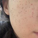 대구한의원 | [대구 한의원] 편평사마귀 거우침으로 제거한 후기