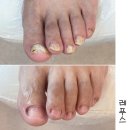 경기광주 발톱무좀 관리는! 경안동 레푸스 (아빠 발/내 돈 내산)