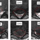 늘푸른날 님의 요추디스크 L3-4, L4-5, L5-S1의 MRI 판독입니다. 이미지