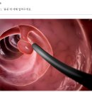 용종·선종·톱니 모양 병변 이란? 이미지