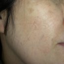 미작프렌차이즈 | 미작뷰티 강동점 | 제로스팟 시술 리뷰 (흑자, 잡티 제거)