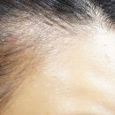 주식회사 포라스 | 여자M자탈모 여자앞머리탈모 포라스나 후기!