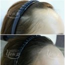 헤어라인 이미지