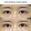 행술 | 소세지눈 재수술 가격 합리적인 선택을 위한 비용 결정 요인