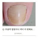 제성당약국 | 무좀약만 발랐는데 왜 두꺼워졌죠?내포문제성네일