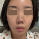 비앤영의원 | 비앤영의원 코젤코, 콧볼축소수술후기 (+회복기간)