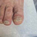 산본천로 | 군포 산본발톱무좀 아빠 발관리 후기 오벨리네일푸스 족보있는그녀들 군포산본점