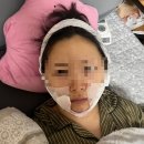 이중턱 지방흡입 한 달 차, 잃어버린 턱선을 찾고 사진 찍는 즐거움을 되찾은 솔직 후기