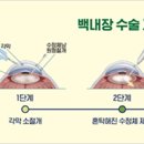 백내장 원인 및 증상 치료 예방 이미지