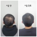하프톤 스칼프 | 대구 탈모인들의 성지 탈모케어 두피SMP 마지막 후기 <하프톤스칼프>
