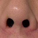 바름한의원 | 노원피부과 한의원 새살침 코흉터치료 3회차 후기