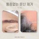 광주 리턴세럼 레이저 NO 통증없이 문신 타투 잔흔 제거 방법 후기