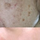 성실약국 | 흑자 크림 약국 처방, 레이저 내돈내산 효과 비교