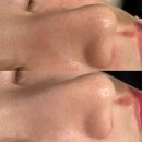 오토스킨위례지사 | [위례 피부관리] “제이엘메이드 스킨케어 센터” 여드름 잡티엔 플라즈마 관리