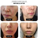 진명한의원 | 매선침 가격과 후기 _ 아미율한의원 강남점