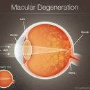 황반변성 망막질환 줄기세포치료 이미지