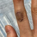 단디병원 | 양산 : 단디병원 손가락 혈종 수술 및 정맥 파열 1️⃣