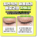 쌍수 매몰 후기 궁금해요? 붓기 빠지는 시기랑 흉터 걱정 없는 방법