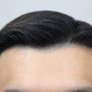 244 | [대다모 포토후기] 30대 남성 4400모 모발이식 244일 후기입니다.