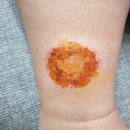 경희수세보원한의원 | [인천 피부 치료 한의원] 화폐상습진의 치료