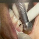 펄서울치과의원 | 물방울 레이져 펄서울치과 도입