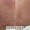 시전 | 여드름패인흉터 제거 치료 어븀레이저 피코프락셀 서브시전 후기