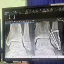 회진시장 | 251215 외측 복숭아뼈 발목골절 수술후기 및 재활기-1