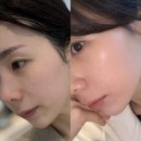 구디스킨부스터 내돈내산 콜라스터 PDRN 포텐자효과 전후비교, 가격, 통증 후기 (피부결 모공 탄력 개선)