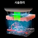태평양의료기 | [신흥역 오아로피부과] 리팟 레이져 시술로 흑자 완벽 제거 효과(feat. 이루다, 제이시스메디컬)
