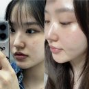 4 | 리쥬란 후기 HB 4cc 가격 종류 효과 총정리