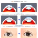 드림콘택트렌즈 이미지