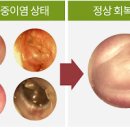 삼출성 중이염 증세 원인 성인 중이염 낫는법 이미지