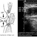 Baker Cyst Imaging 이미지