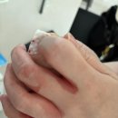 부산 칼에 손 베임 병원 진료 후기(봉합 여부 / 대처법)