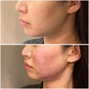 멍피스 | 압구정역피부과 처진 피부 끌어올리는 인모드 Fx 포마 얼굴전체 후기 ,멍