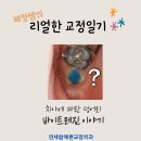 혜정치과의원 | 동탄교정치과 교정일기 6) 어금니 씹는면에 파란색 덩어리가 뭔가요? '바이트레진'입니다.