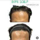 돕스칼프 | 남포동두피문신잘하는곳 돕스칼프 헤어라인흉터커버교정 후기